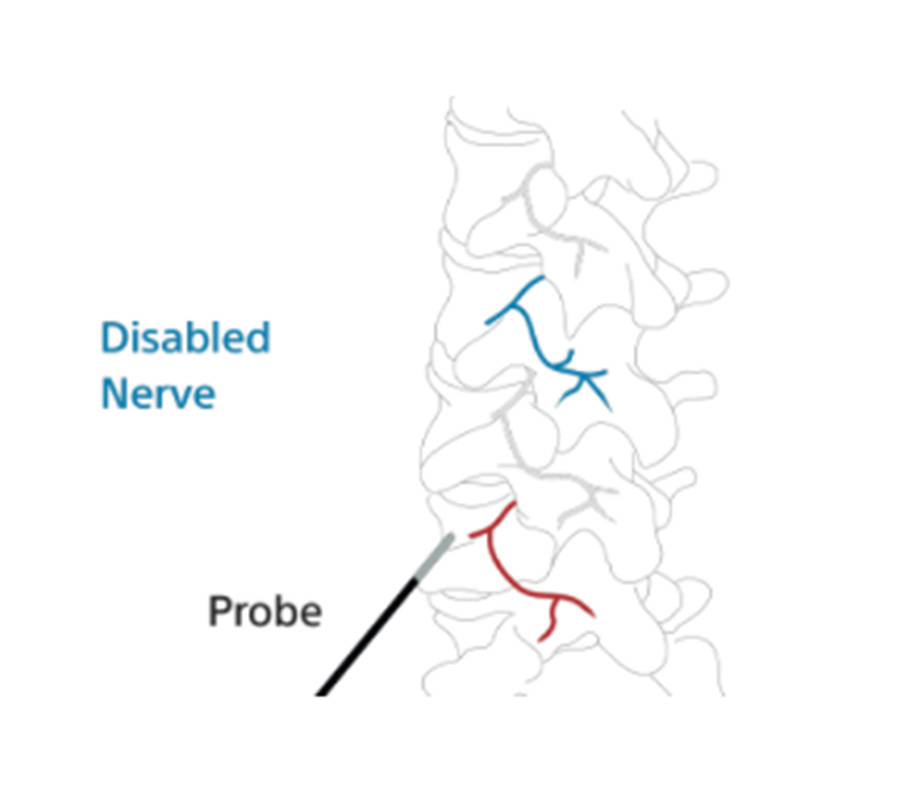 Illustration of how to disable the nerve