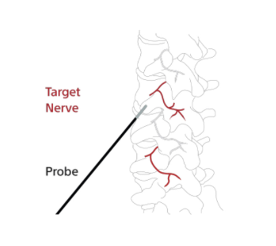 Illustration of how to target the nerve