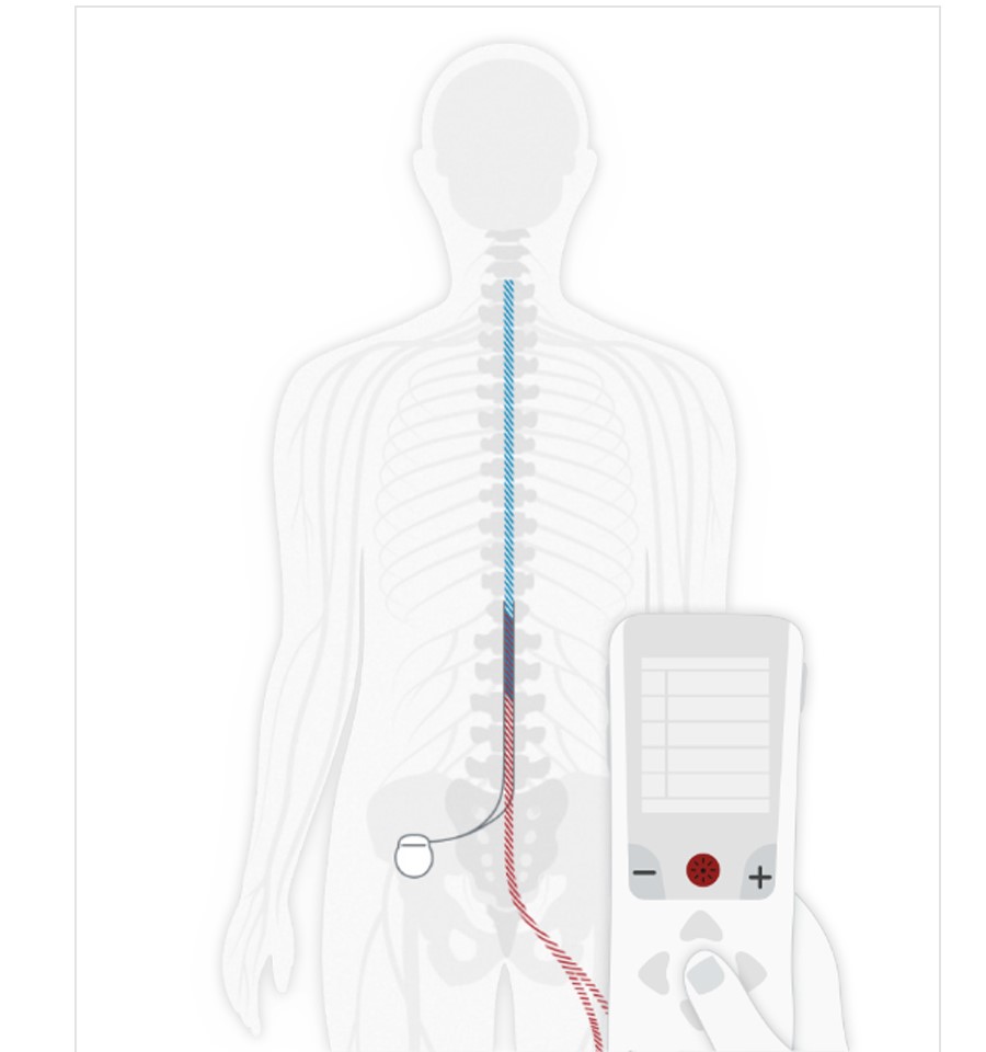 illustration showing how SCS works in body