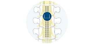 Illumina 3D SCS device