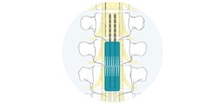 Contour SCS device