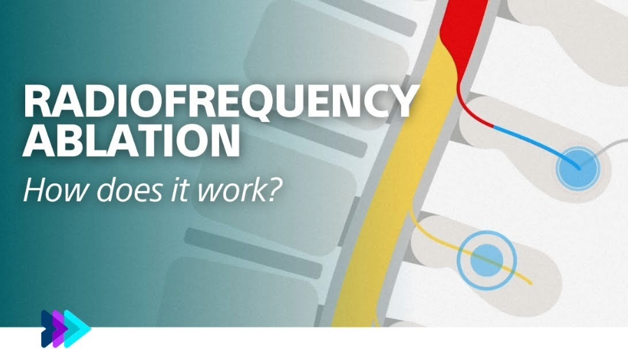 Radiofrequency Ablation Effective Pain Management
