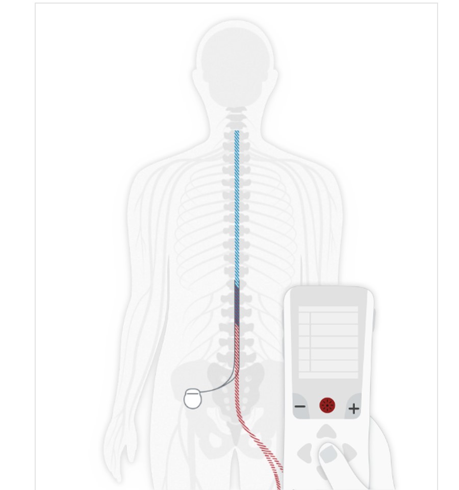 Diagram showing spinal cord stimulation device with remote control